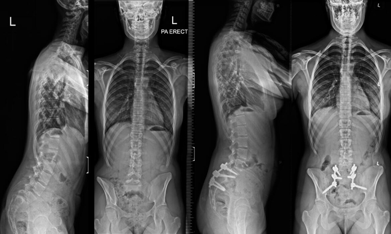 Fig. 2 
            Preoperative and postoperative full-spine radiographs of a 14-year-old girl who underwent partial reduction, transfixation and additional stabilization of the rods from L5 to the pelvis for a grade 3 dysplastic spondylolisthesis with preoperative global imbalance which was corrected after surgery.
          