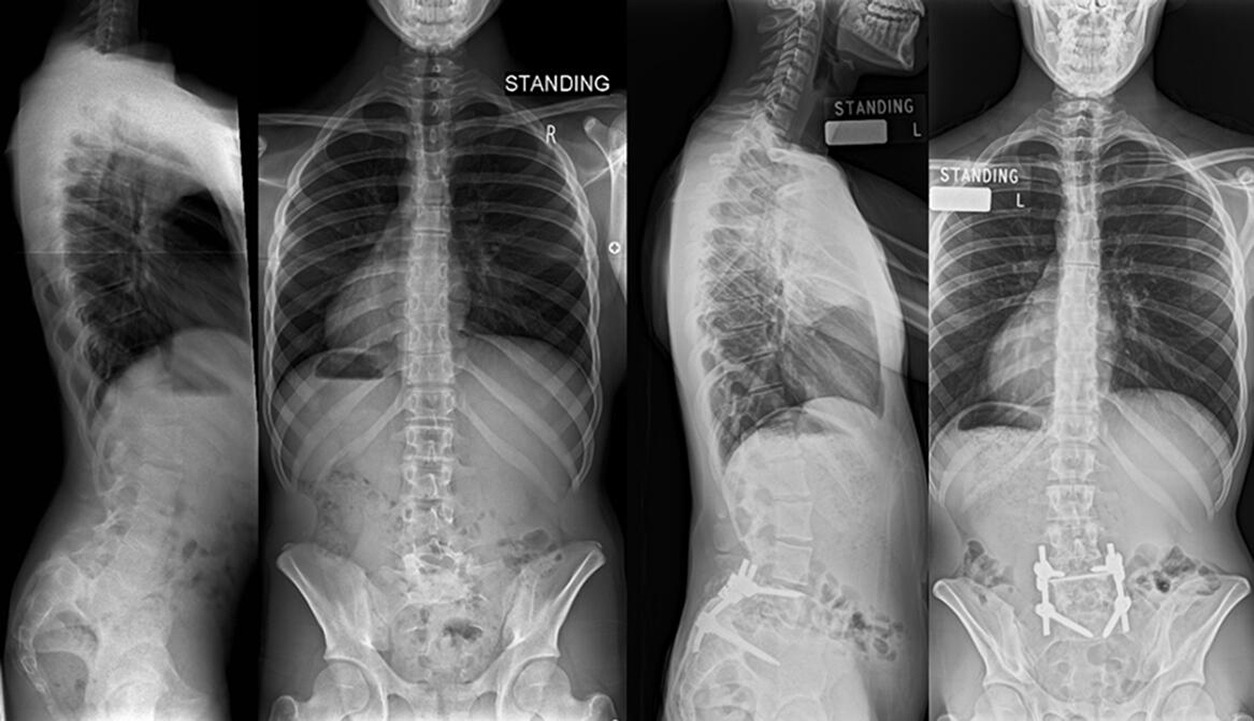 Fig. 3 
            Preoperative and postoperative full-spine radiographs of a 14-year-old boy who underwent partial reduction, transfixation and proximal fixation of the rods to L4 for a grade 4 dysplastic spondylolisthesis with a globally balanced spine preoperative and at final follow-up.
          