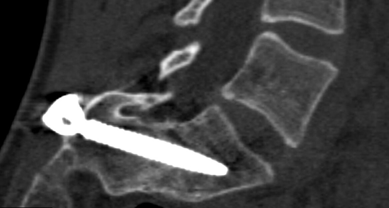 Fig. 4 
            Sagittal CT reconstruction showing anterior interbody fusion around a S1-L5 transfixation screw.
          