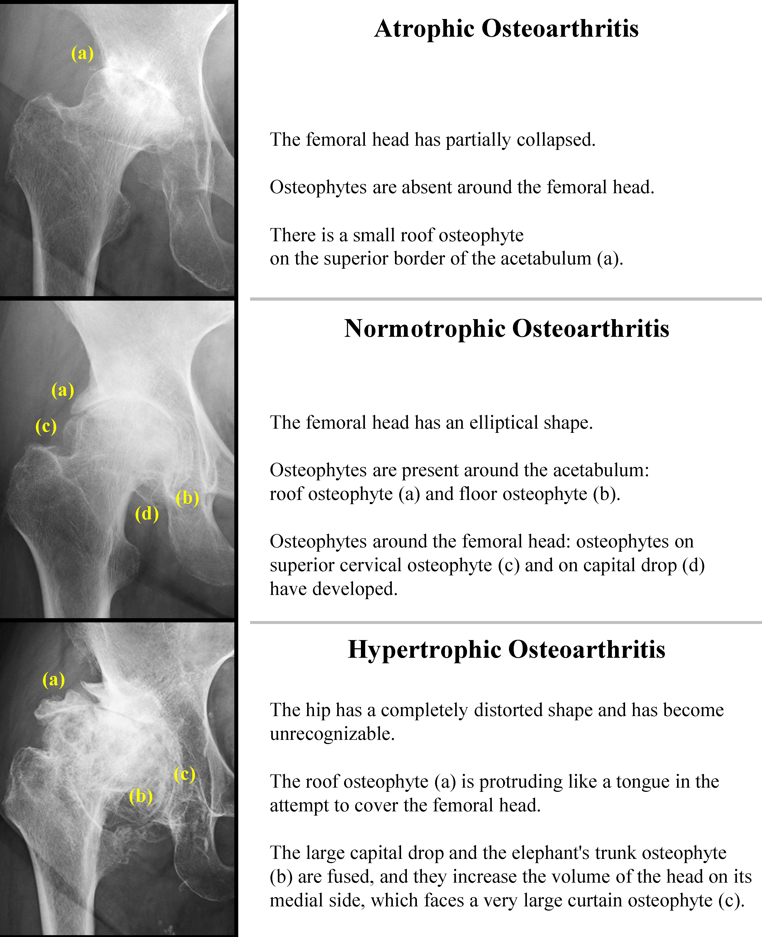 Fig. 3 
            The biological-reaction classification of hip osteoarthritis according to Bombelli.37
          