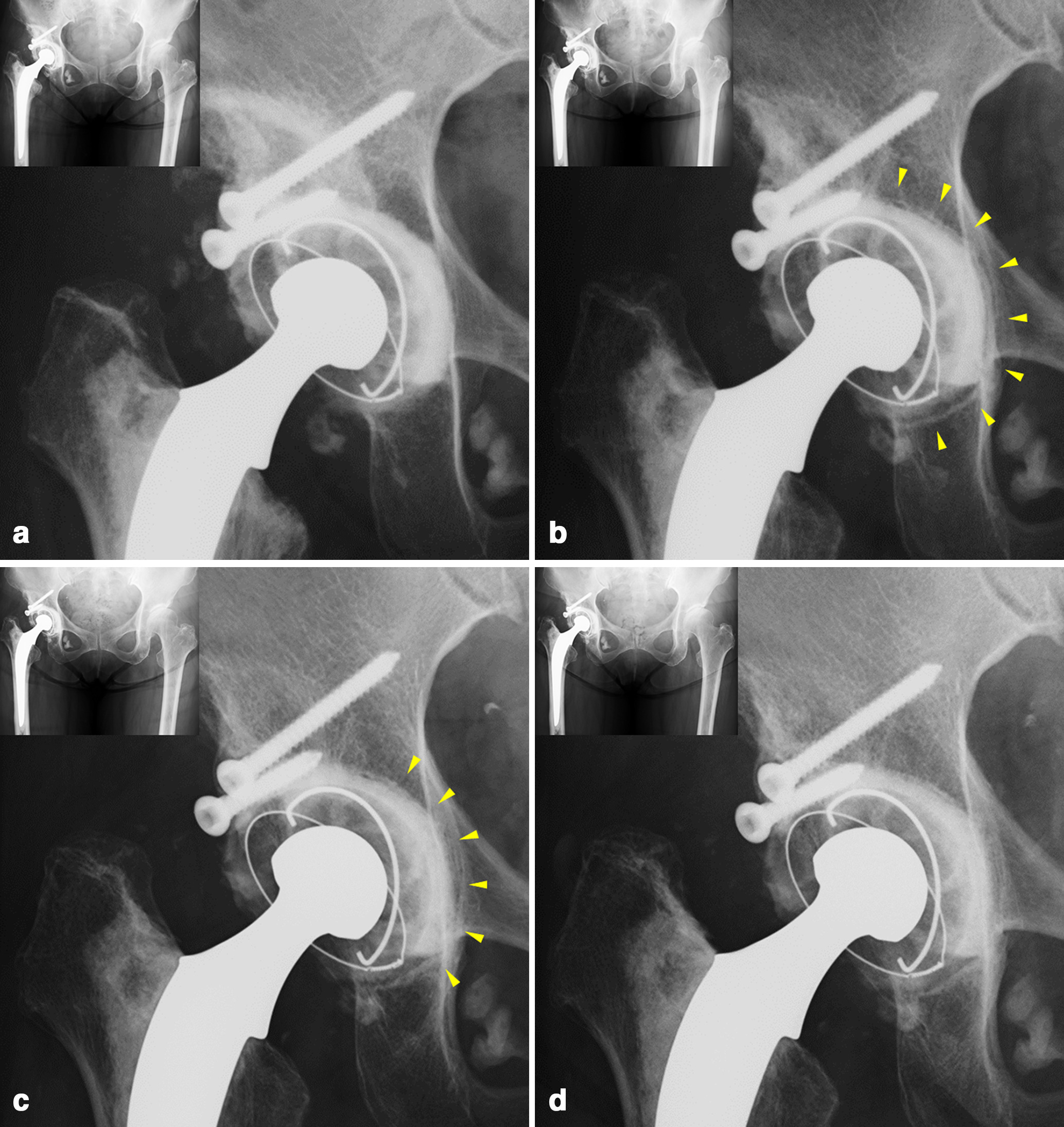 Fig. 5 
          Postoperative radiographs of a 61-year-old woman with primary cemented total hip arthroplasty. a) One week postoperatively; b) one year postoperatively, the yellow arrow indicates a radiolucent line at the cement-bone interface in DeLee Charnley zones 2 and 3; c) five years postoperatively, the yellow arrow indicates the improvement in the radiolucent line at the cement-bone interface in DeLee Charnley zone 2 and part of zone 3; and d) nine years postoperatively, improvement of the cement-bone interface was maintained.
        