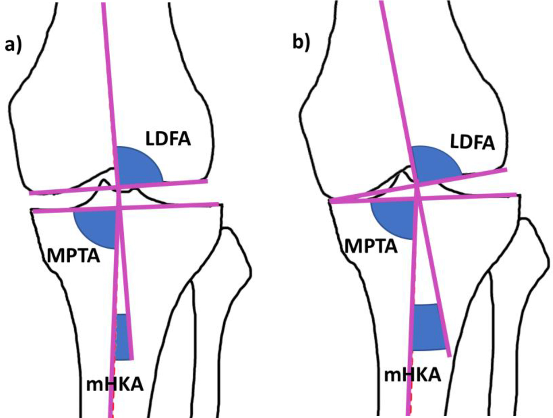 Fig. 1 
            Changes in coronal alignment and mechanical hip-knee-ankle angle (mHKA) in degenerative arthritis. a) Lateral distal femoral angle (LDFA), medial proximal tibial angle (MPTA) and mHKA in a knee with preserved joint space and mild constitutional varus alignment. b) The same knee following degenerative loss of medial joint space, showing a change in mHKA and no change to LDFA and MPTA.
          