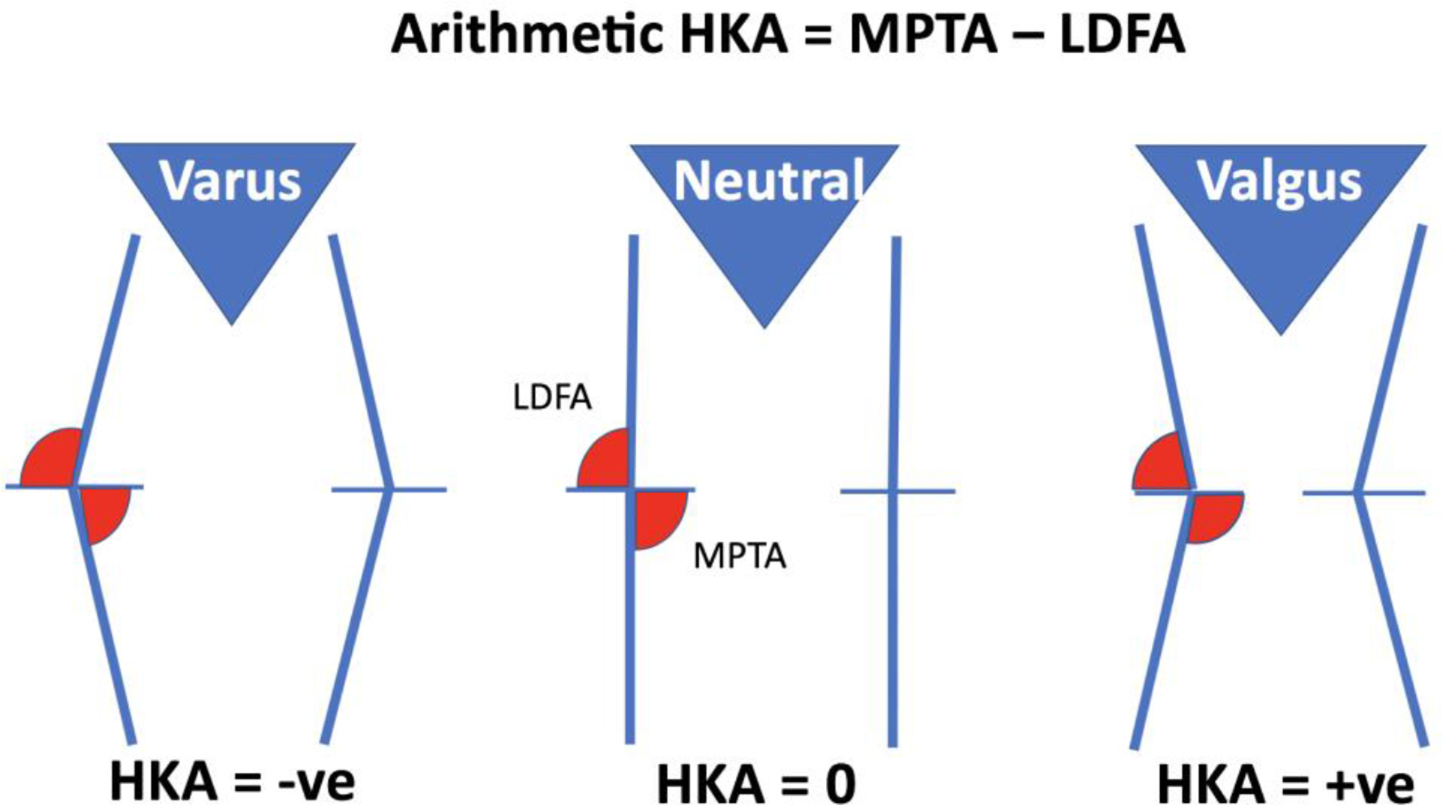 Fig. 2 
            Relationship between the lateral distal femoral angle (LDFA) and medial proximal tibial angle (MPTA) in varus, neutral, and valgus lower limb alignment with the arithmetic hip-knee-ankle (aHKA).
          