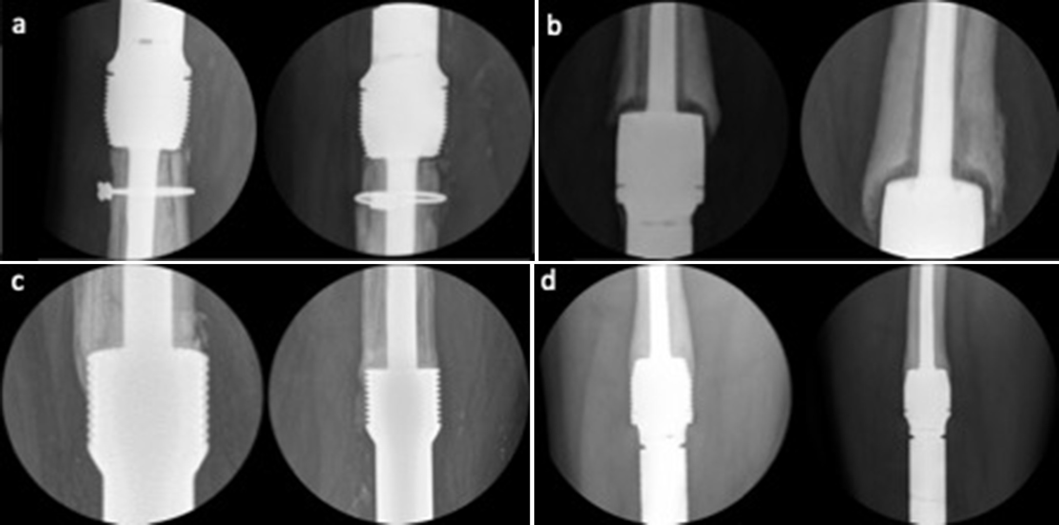 Fig. 1 
          AP and lateral plain radiographs representing the four grades of growth: a) Grade 1: No osseointegration or bone growth. b) Grade 2: Bone growth around collar with gap between new bone and collar. c) Grade 3: Osseointegration in 1 or 2 zones. d) Grade 4: Osseointegration in 3 or 4 zones.
        