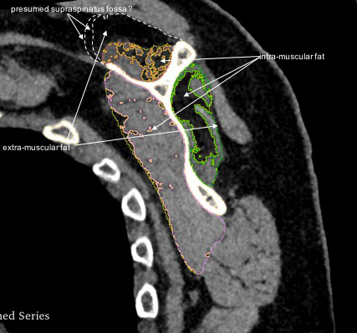 Fig. 1 
          Sagittal view of a right shoulder in a cuff tear arthropathy patient with severe fatty infiltration of the supraspinatus, infraspinatus and teres minor. The contours of the different muscles and their intramuscular fat can be seen. This example shows the difficulty to define precisely the contour of the presumed supraspinatus fossa.
        