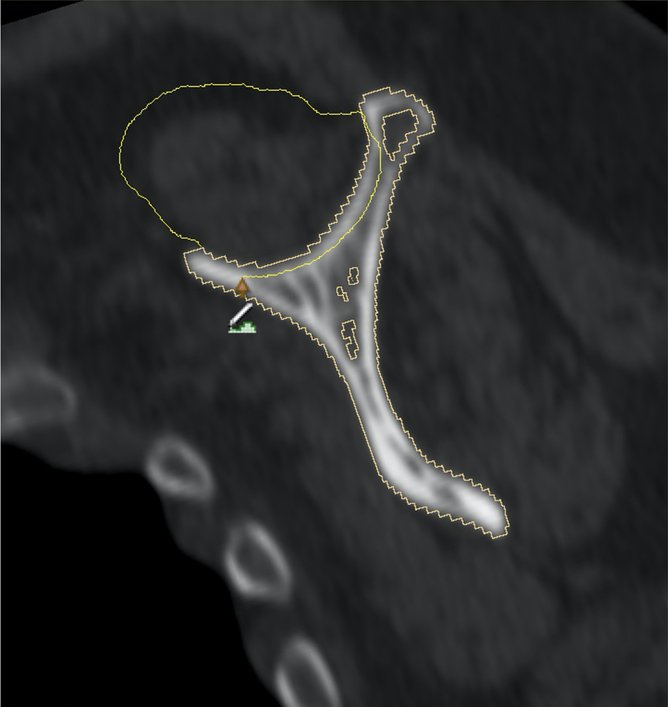 Fig. 3 
            Example of rotator cuff muscle segmentation on a sagittal view from the soft tissue DICOM (Digital Imaging and Communications in Medicine) series: the threshold draw tool in the editor module of the Slicer version 4.10.0 software (Slicer Community, USA) is used to draw a line along the contour of the supraspinatus.
          
