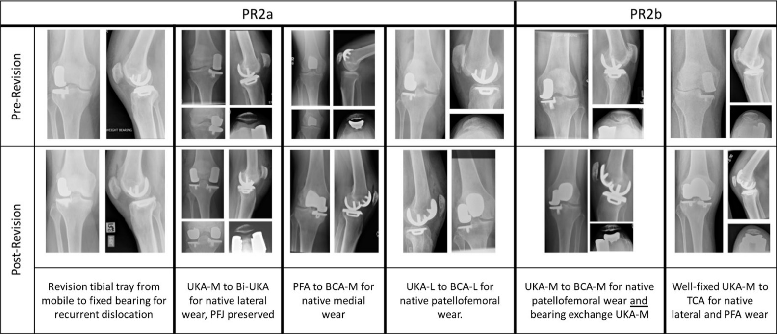 Fig. 2 
          Radiographic examples of partial revision two (PR2) procedures. BCA-L, lateral bicompartmental arthroplasty; BCA-M, medial bicompartmental arthroplasty; Bi-UKA, bi-unicondylar athroplasty; PFA, patellofemoral arthroplasty; PTCA, tricompartmental arthroplasty; UKA-L, lateral unicompartmental arthroplasty; UKA-M, medial unicompartmental arthroplasty.
        