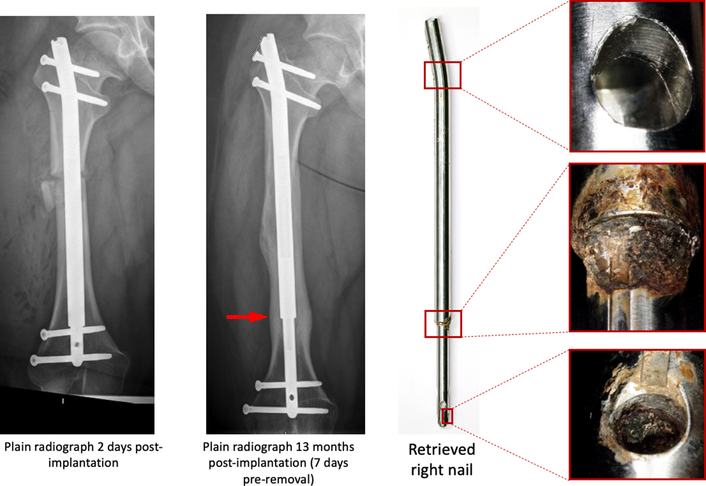 Fig. 10 
            Images showing immediate postimplantation and preremoval plain radiographs of Patient 2 implanted with a right femoral nail, removed after 13 months. There is evidence of clear cortical thickening around the extendable junction on the pre-removal radiograph (right arrow). This corresponds with retrieval evidence of severe corrosion at this junction, as well as at the most distal nail-screw junction.
          