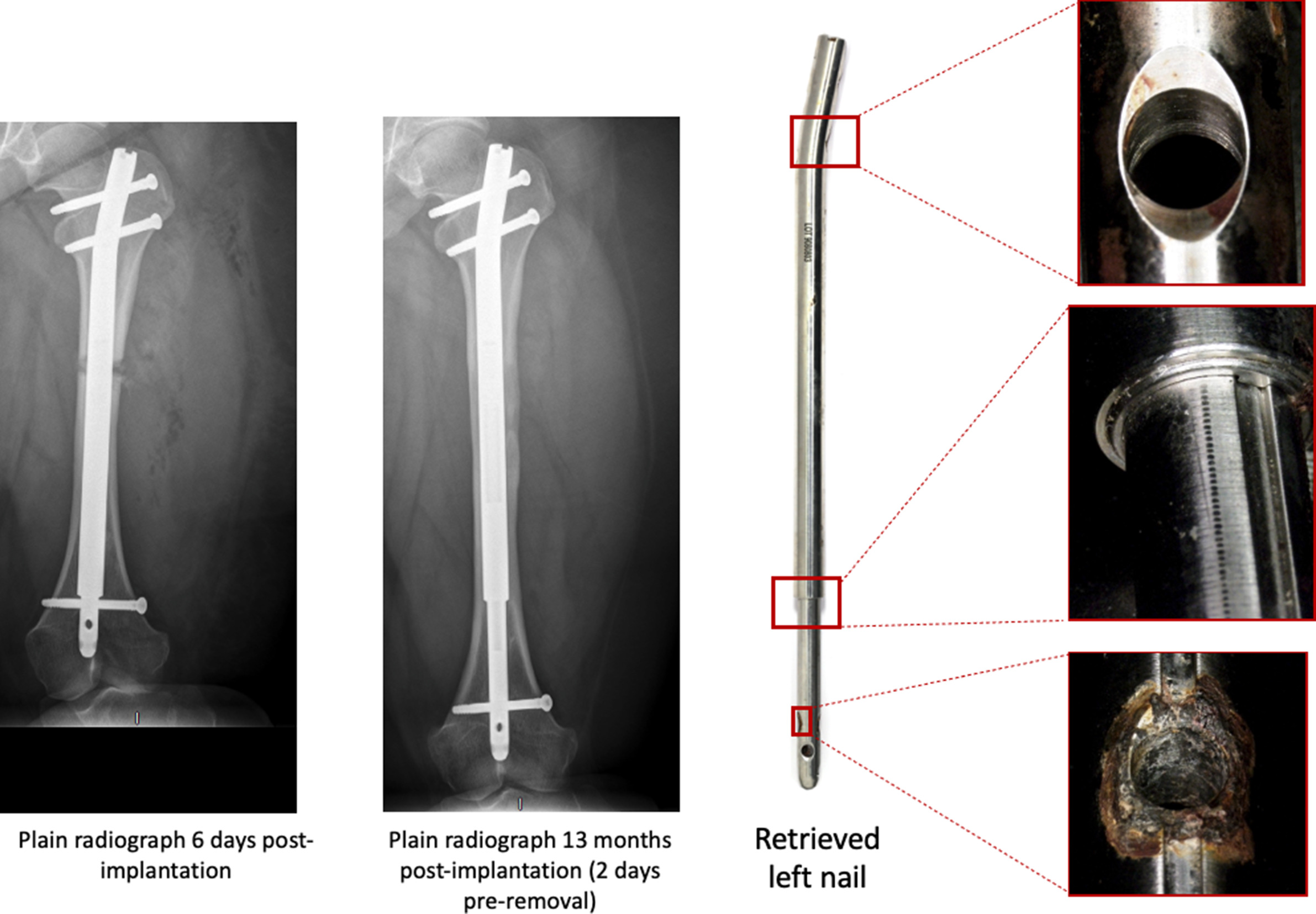 Fig. 11 
            Images showing immediate postimplantation and preremoval plain radiographs of Patient 2 implanted with a left femoral nail, removed after 13 months. The cortical thickening observed around the right nail junction is not observed here. Retrieval analysis found no evidence of corrosion at the extendable junction of this left nail. However, there was severe corrosion within one of the distal nail-screw junctions.
          
