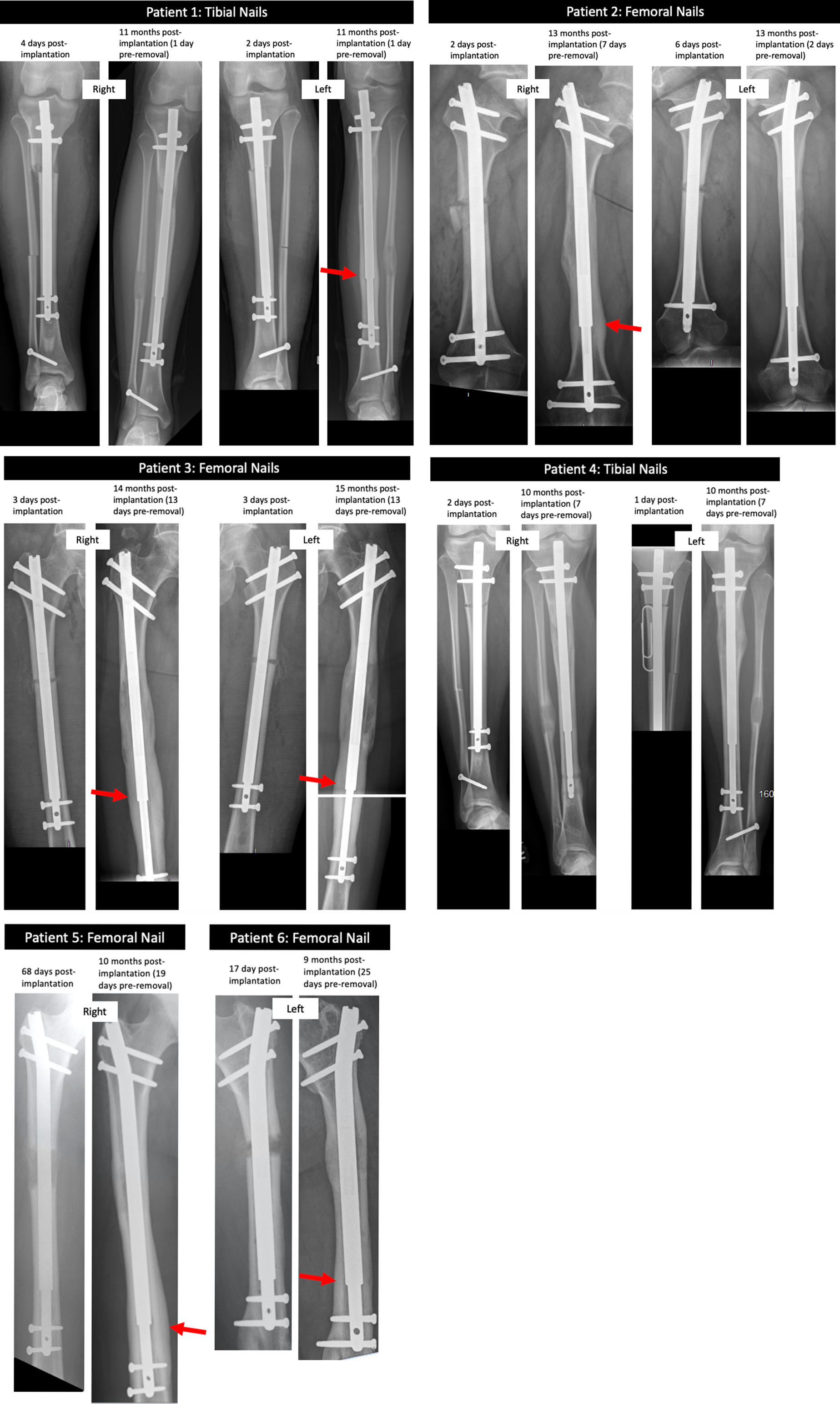 Fig. 3 
            Plain radiographs captured of each patient post-implantation of each nail, and pre-removal. Patients 1, 2, 3, 5, and 6 showed evidence of cortical thickening and osteolysis preremoval in bony regions aligned with the extendable junction of the nails (red arrows).
          