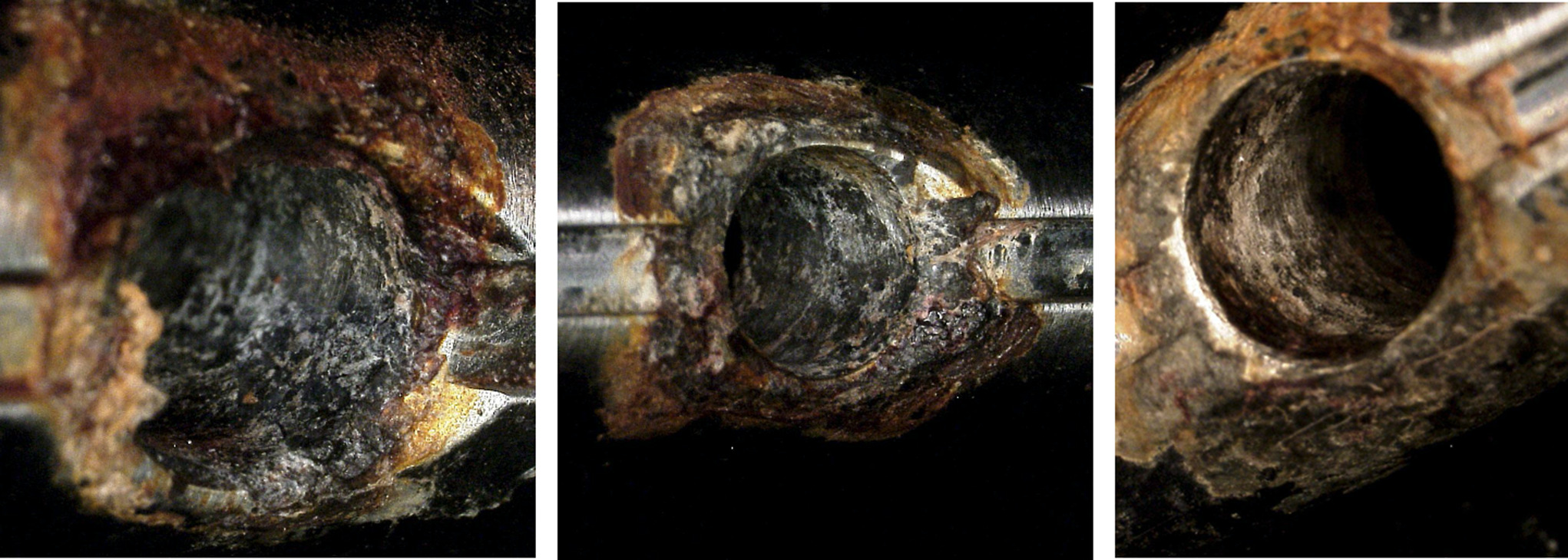 Fig. 7 
            Microscopic images showing evidence of severe corrosion (Goldberg score 4) within the nail-screw junction holes. This was observed in ten out of the 54 screw holes examined.
          