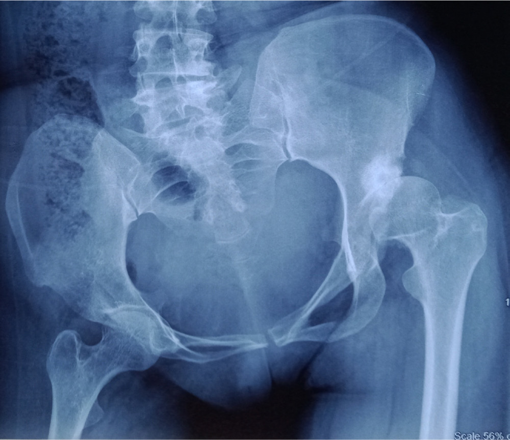 Fig. 2 
          Radiograph of pelvis with both hips in a 30-year-old female with post-polio residual paralysis affecting her right lower limb. She was walking with hand to knee (right side) gait. She presented with pain in left hip. Note the arthritic changes in her left hip and tilting of pelvis towards right side. She also had flexion contracture in right knee.
        