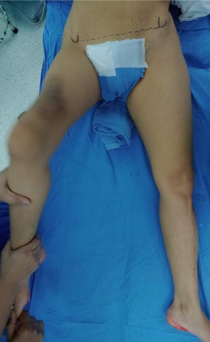 Fig. 3 
          Clinical photograph of the 30-year-old female showing pelvis tilted to right side. On clinical examination, she had tight Iliotibial band.
        