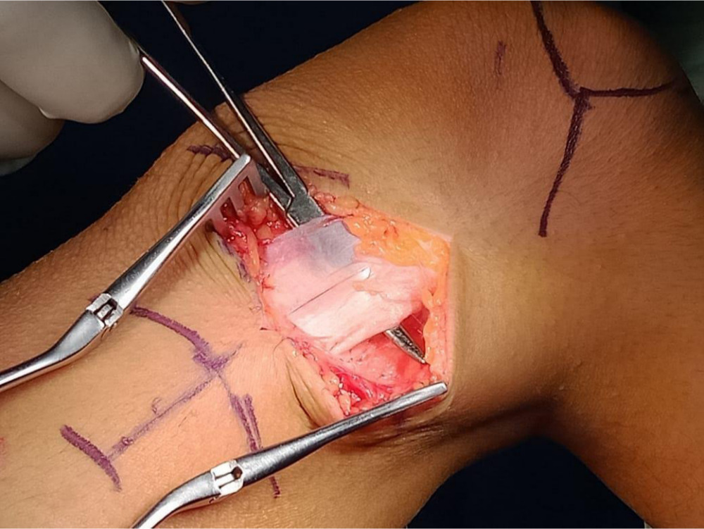 Fig. 4 
          Intraoperative picture showing exposure of tight iliotibial band for Yount’s release.
        