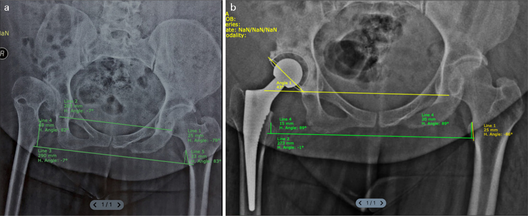 Fig. 8 
            a) Preoperative radiograph showing hip arthritis with subluxation in a paralytic right lower limb due to polio; b) Six years follow-up following right total hip arthroplasty. Note the stable hip prosthesis is situ.
          