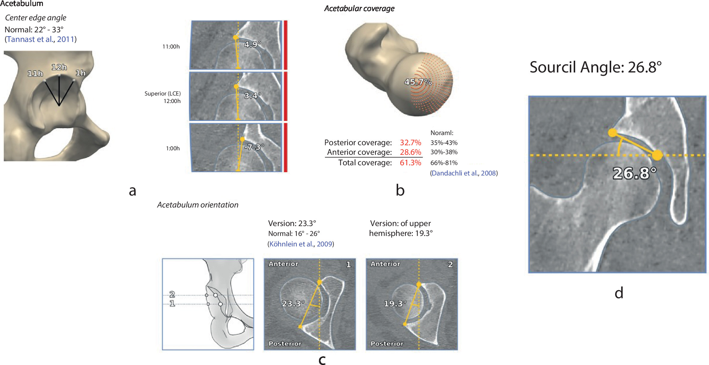 Fig. 2 
            Sample of 3D CT measurements depicting a) lateral centre edge angle at 11:00, 12:00, and 1:00 (referred to as 13:00 in this article), b) femoral head cover, c) acetabular version, and d) acetabular index (referred to as sourcil angle by the Clinical Graphics analysis).
          
