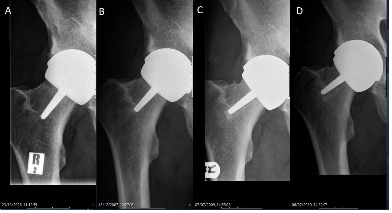 Fig. 4 
          Serial radiographs in a 59-year-old man who underwent hip resurfacing arthroplasty for rheumatoid arthritis. From the left to right: a) initial postoperative view; b) at one year post-surgery; c) a ‘divot sign’ is obvious on the superior aspect of the femoral neck at three years.
        