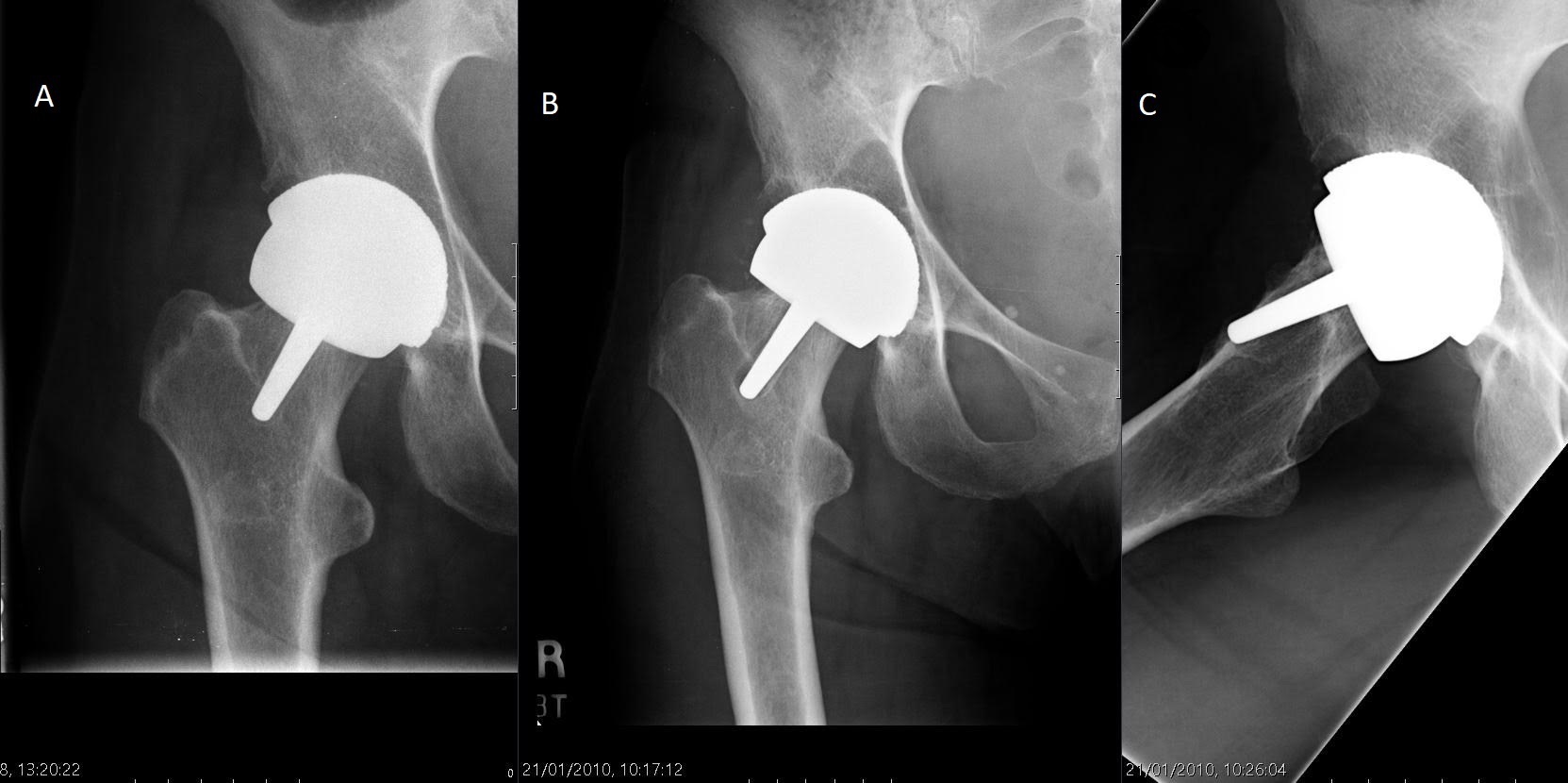 Fig. 5 
          Hip radiographs in a 56-year-old woman. From left to right: a) immediate postoperative view; b) two years following index surgery extensive lysis had formed behind the acetabular component and radiolucency was observed around the femoral peg; c) lateral view at two years showing resorption of bone beneath the femoral component causing loosening and migration of the femoral component. Revision was undertaken.
        