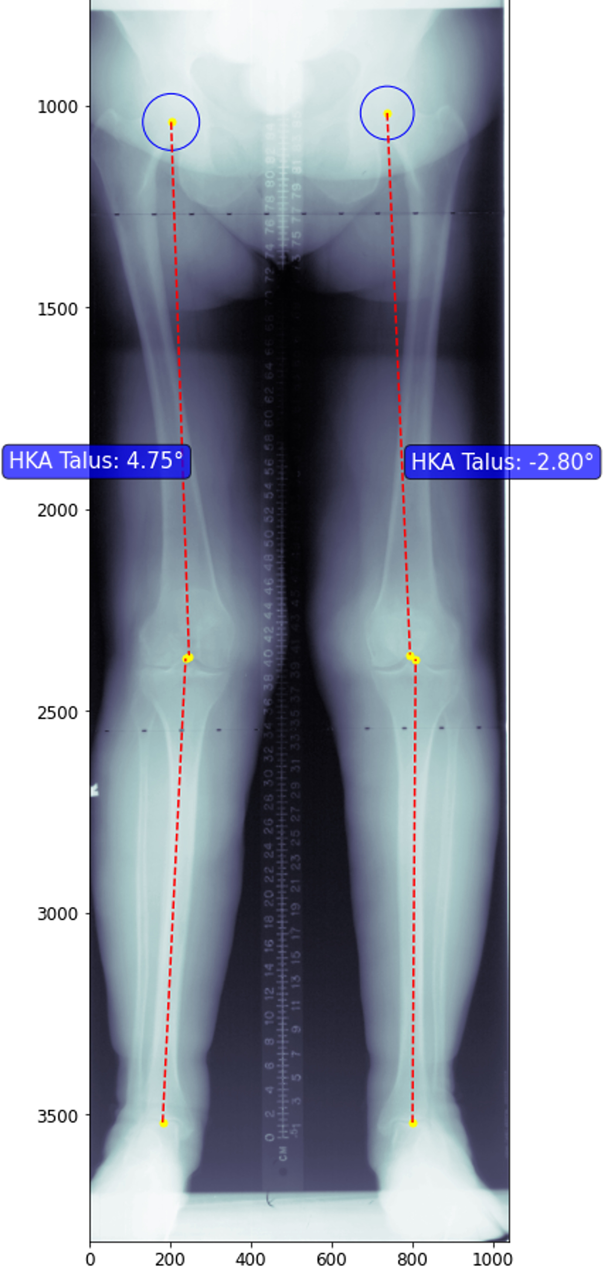 Fig. 2 
            Hip-knee-ankle (HKA) angle, defined as angle subtended by the femoral and tibial mechanical axes (red lines). Positive values recorded as valgus and negative values recorded as varus.
          