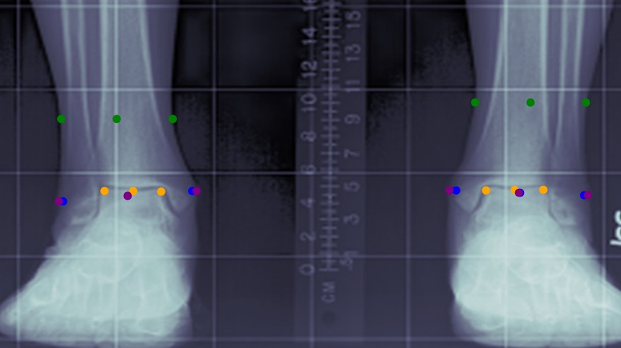 Fig. 3 
            Distal anatomical landmarks based on colour. Orange = radiological ankle center. Blue = medial and lateral malleoli. Purple = soft tissue overlying malleoli. Green = soft tissue sulcus.
          
