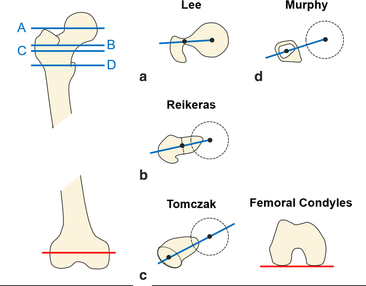 Fig. 1 
            Schematic illustration of the different methods of femoral version measurement.
          