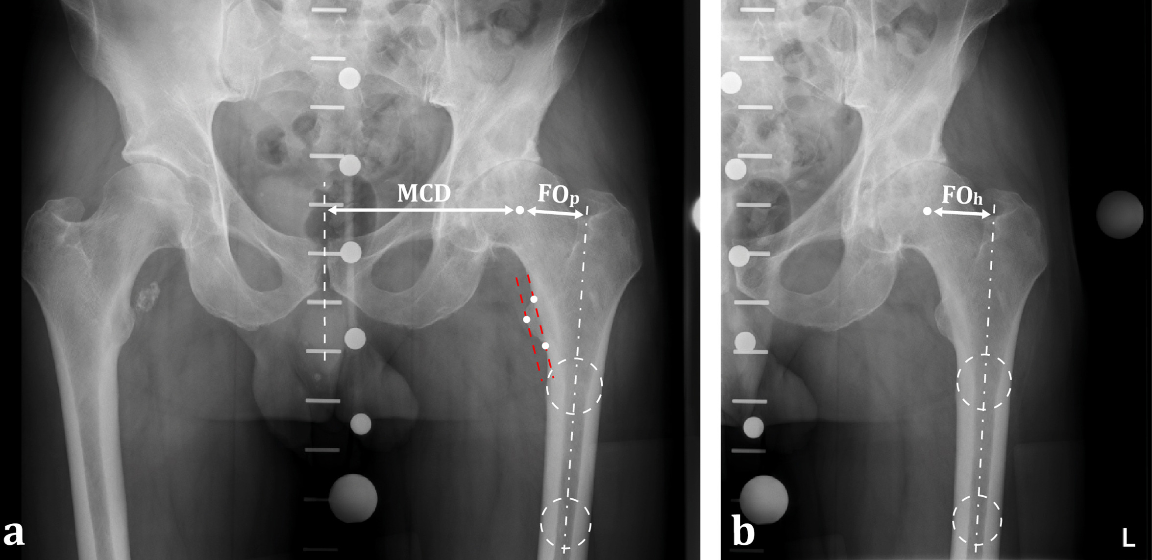 Fig. 1 
            a) Preoperative anteroposterior (AP) pelvis radiograph with KingMark calibration markers. Femoral offset (FOp) was calculated as the perpendicular distance between the femoral shaft axis and the femoral head centre. The mid-centre distance (MCD) was defined as the shortest distance between the midline of the pelvis and the centre of the femoral head. Rotation of the femoral neck to the detector plane was assessed using the thickness of the lesser trochanter (TLT) defined by the perpendicular distance between the two dotted parallel lines; the proximal and distal cortical intersection between the lesser trochanter and the femoral cortex defined the first line, and the outer prominent contour of the lesser trochanter defined the second line. b) Preoperative AP hip radiograph with KingMark calibration markers and femoral offset measurement (FOh).
          