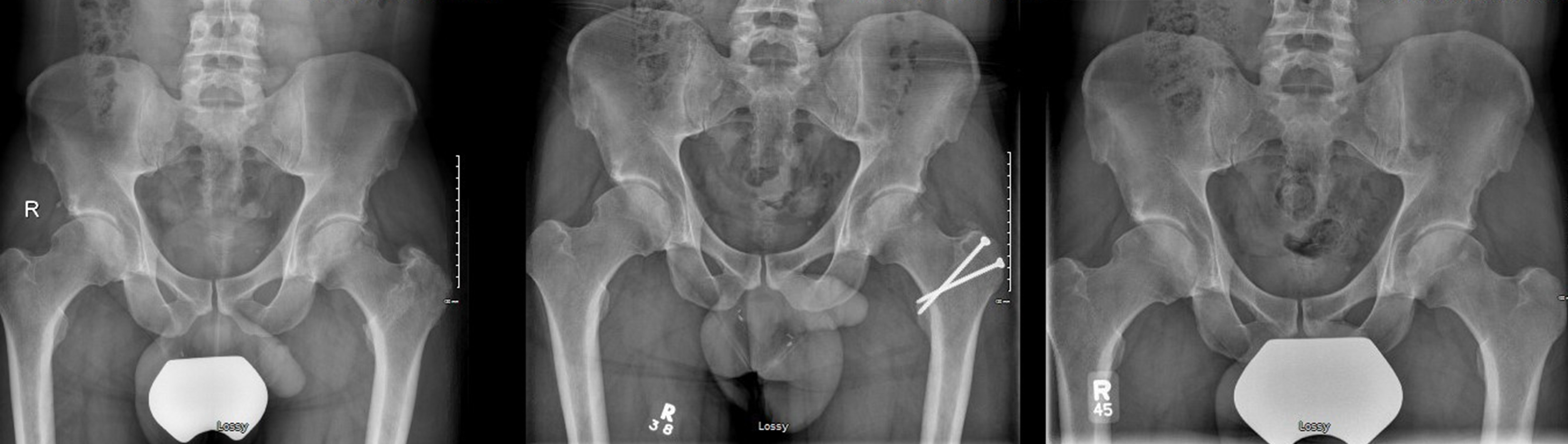 Fig. 1 
            Preoperative, immediate postoperative, and ten-year follow-up anteroposterior radiograph of a patient who underwent open surgical dislocation, labral repair, and femoral osteochondroplasty for the treatment of cam type femoroacetabular impingement.
          