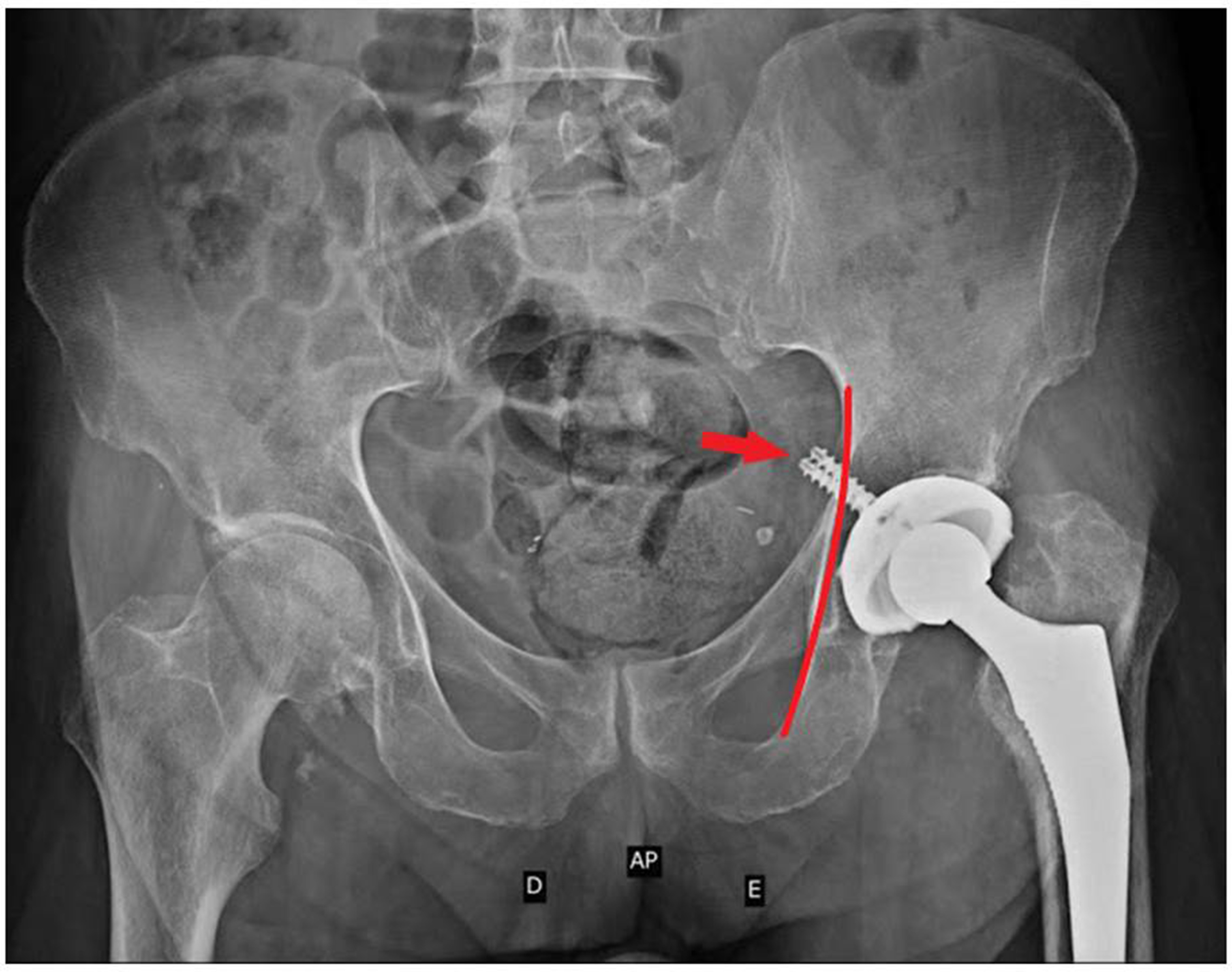 Fig. 1 
          Pelvis anteroposterior radiograph demonstrating two screws (red arrow) overlapping the ilio ischiatic line (red line) > 5 mm. It is a red flag to vascular injury during revision total hip arthroplasty.
        
