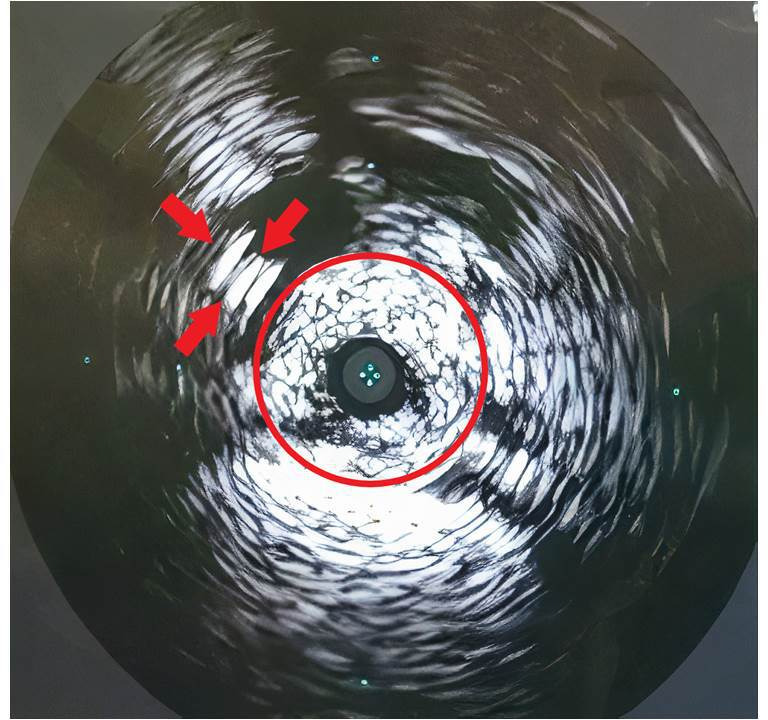 Fig. 3 
          Intravascular ultrasound image. Vein wall (red circle) is extremely close (< 5 mm) to the screw (red arrows).
        