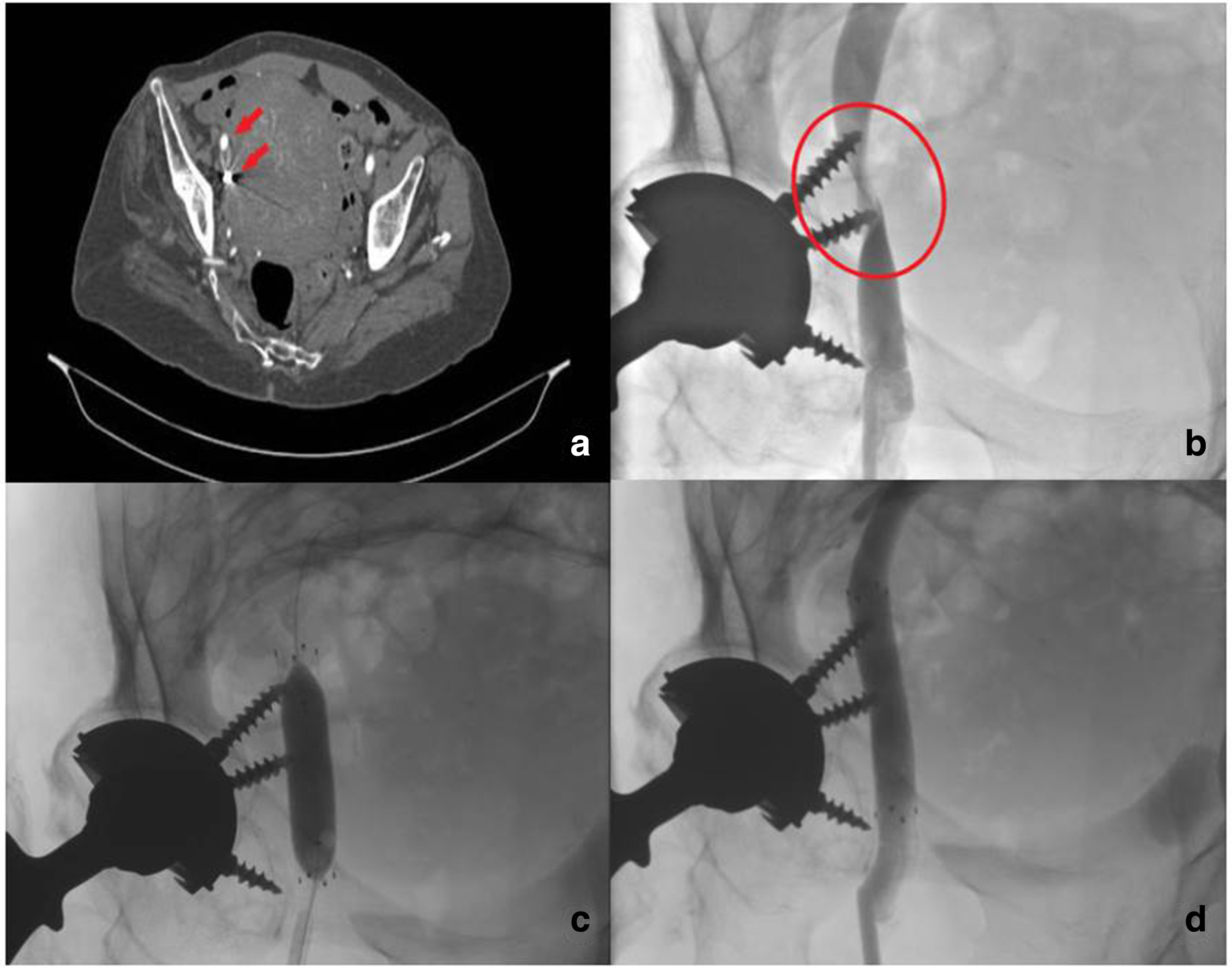 Fig. 4 
          a) CT pelvis showing intrapelvic screws (red arrows) on the right side.b) Venography demonstrating iliac external vein stenosis caused by screws. c) Venography showing balloon at the stenosis site.d) Venography after stent insertion. The image shows the full flow in iliac external vein. The patient was prescribed dual antiplatelet therapy with 100 mg of aspirin and 75 mg of clopidogrel daily for four weeks since the literature suggests that this a critical period o for early stent occlusion. Before surgery, antiplatelets were suspended one week before the planned surgery.
        