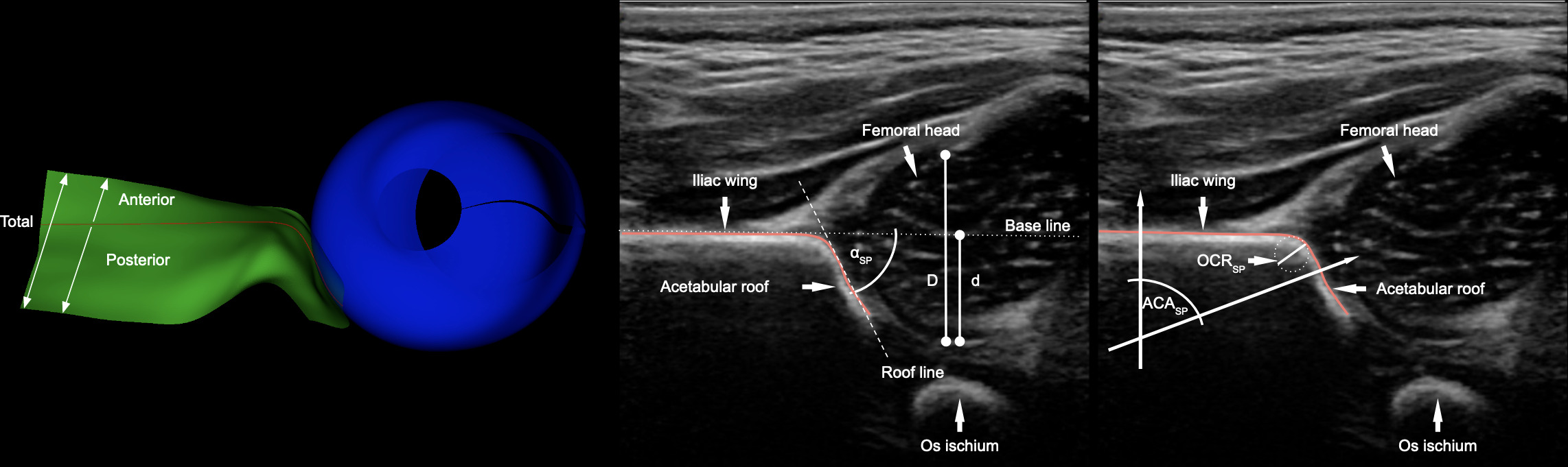 Fig. 1 
          Left: Acetabular surface model (ASM). Green part of the model represents iliac bone and acetabulum; blue part approximates femoral head. Standard plane contour (SPC; red) delineates the intersection of Graf’s standard plane (SP) and ASM. Middle: Coronal section of 3D ultrasound scan representing manually selected Graf’s SP and schema of α angle (αSP) and femoral head coverage (FHCSP = d/D). αSP and FHCSP are calculated semi-automatically from SPC (red) in a similar manner to the routine ultrasound examination. Right: ACASP is calculated from normal vectors of the SPC (red). OCRSP is the largest circle fitting under SPC to approximate the roundedness of the rim.
        