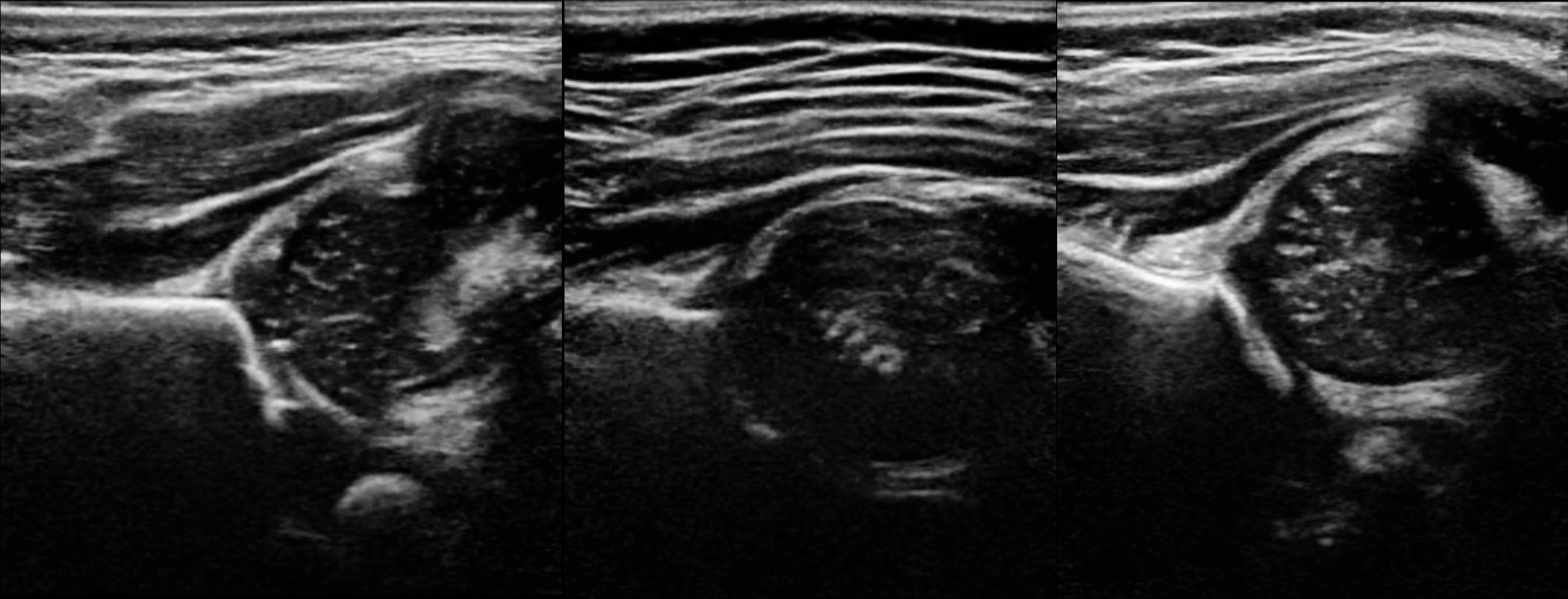 Fig. 2 
          Coronal slices representing examples of included (left) and excluded (middle, right) 3D hip ultrasound scans (3DUS). Left: Slice meets Graf‘s standard plane criteria. Middle: Os ichium is missing in all slices of 3DUS. Right: Iliac wing is not horizontal in any slice of 3DUS.
        