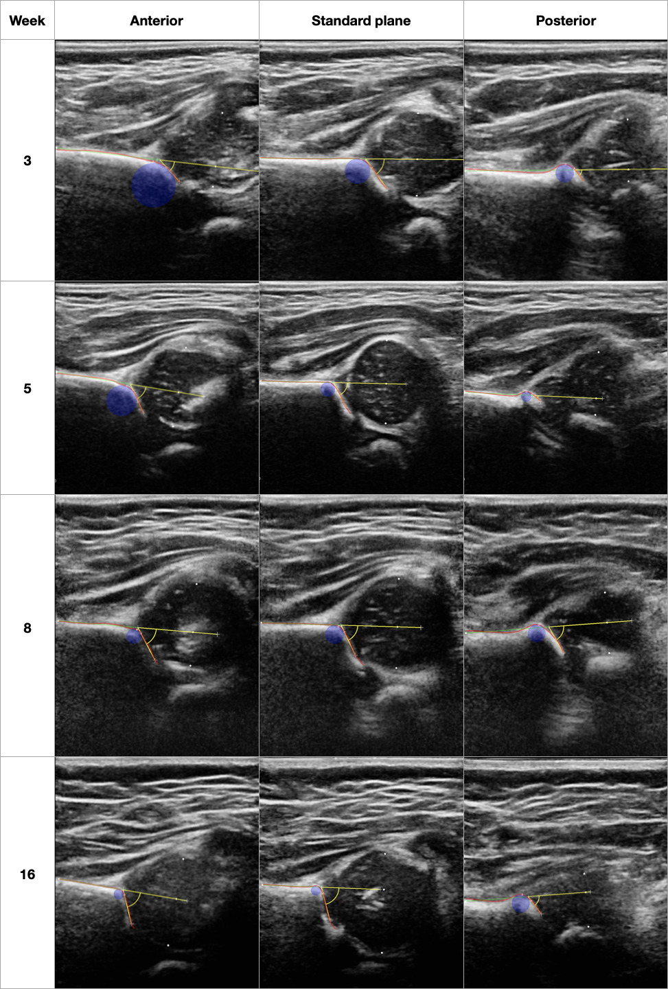 Fig. 3 
          Variation of hip shape by age and anteroposterior location in the joint. Typical images from 3D ultrasound scans in different female left hips at age three, five, eight, and 16 weeks (in rows) demonstrating shape of hip in Graf’s standard plane (SP) as well as in anterior and posterior regions. α angle (yellow), femoral head coverage (FHC; represented by white dots), and osculating circle radius (OCR; blue circle) indices were calculated semi-automatically from countours (red). Note that the acetabulum is generally steeper in the Graf’s SP than in the anterior slices, and also is perceptibly steeper in older patients than younger. In these patients: week 3: αSP = 56.1°, FHCSP = 44.9%, acetabular contact angle (ACA)SP = 54.7°, OCRSP = 21.4mm; week 5: αSP = 62.3°, FHCSP = 47.8%, ACASP = 56.3°, OCRSP = 13.5mm; week 8: αSP = 63.0°, FHCSP = 46.2%, ACASP = 59.3°, OCRSP = 17.0mm; week 16: αSP = 72.2°, FHCSP = 62.3%, ACASP = 68.5°, OCRSP = 9.6mm.
        