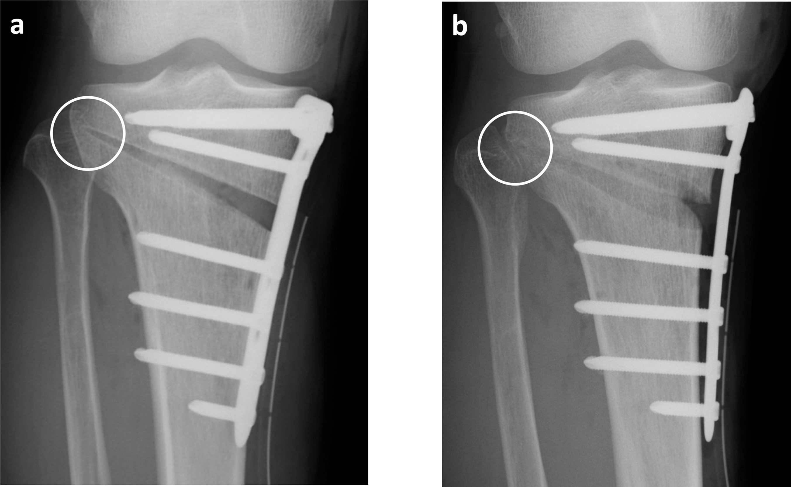 Fig. 2 
            For this 52-year-old female patient, the target site was marked on the lateral hinge using a) anteroposterior radiograph and b) internal rotation view. These radiographs were taken immediately after the operation.
          