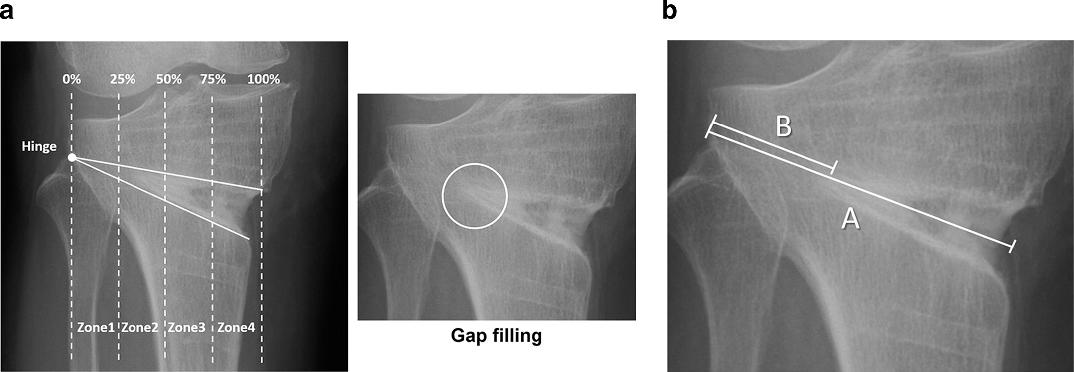 Fig. 3 
            Radiographs taken from a 56-year-old female patient at one-year follow-up post-surgery. a) The osteotomy gap was divided into the lateral hinge and four zones on anteroposterior radiographs, and the zone in which trabecular bone continuity could be observed was defined as gap filling. b) Result of (Distance B/Distance A) × 100 was the progression rate of gap filling.
          