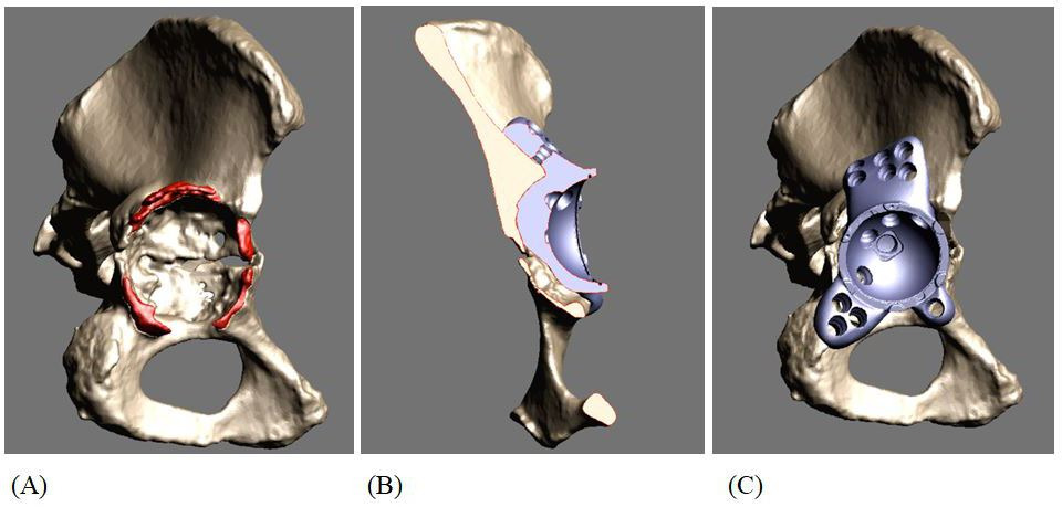 Fig. 1 
            a) 3D reconstruction of a hemipelvis created from a CT image. b) 3D reconstruction of a hemipelvis visualizing the host bone implant distance. c) 3D reconstruction of a hemipelvis with a proposed implant design.
          