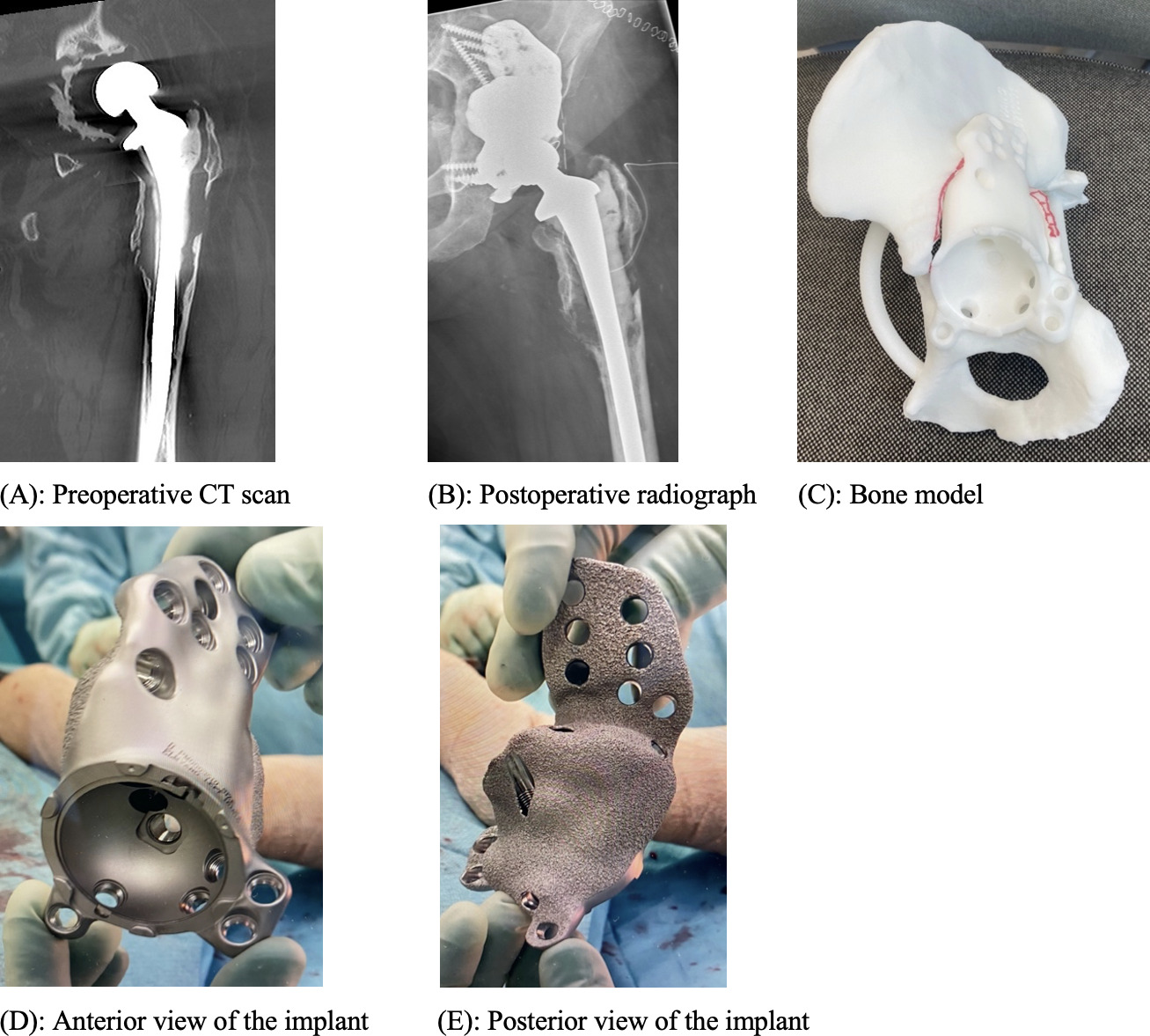 Fig. 2 
            a) Preoperative CT scan with pelvic discontinuity of a 72-year-old female, coronal view. b) One day postoperative radiograph, anteroposterior view. c) Bone model. d) and e) Porous titanium triflange component forms a non-hemispherical shape against the acetabulum, creating optimal bone contact. All flange screws are locking screws to optimize stability.
          