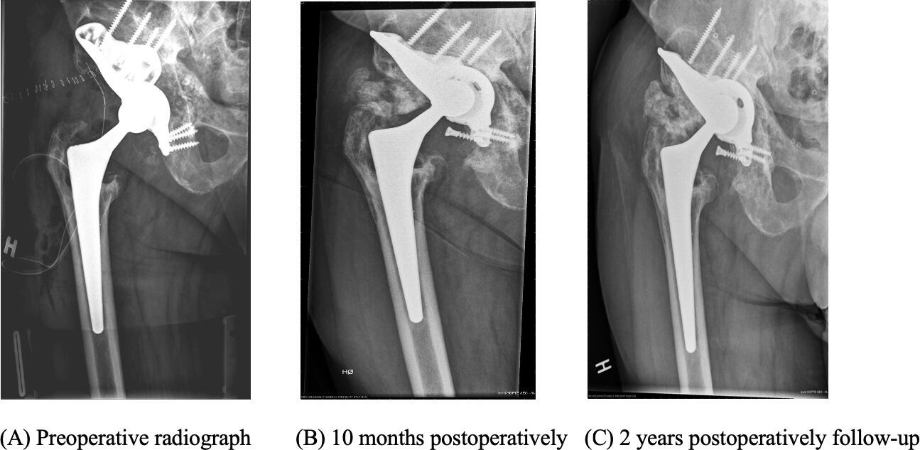 Fig. 3 
          a) Preoperative radiograph of a 74-year-old male, anteroposterior view. b) Postoperative at ten months. c) Postoperative follow-up at two years.
        