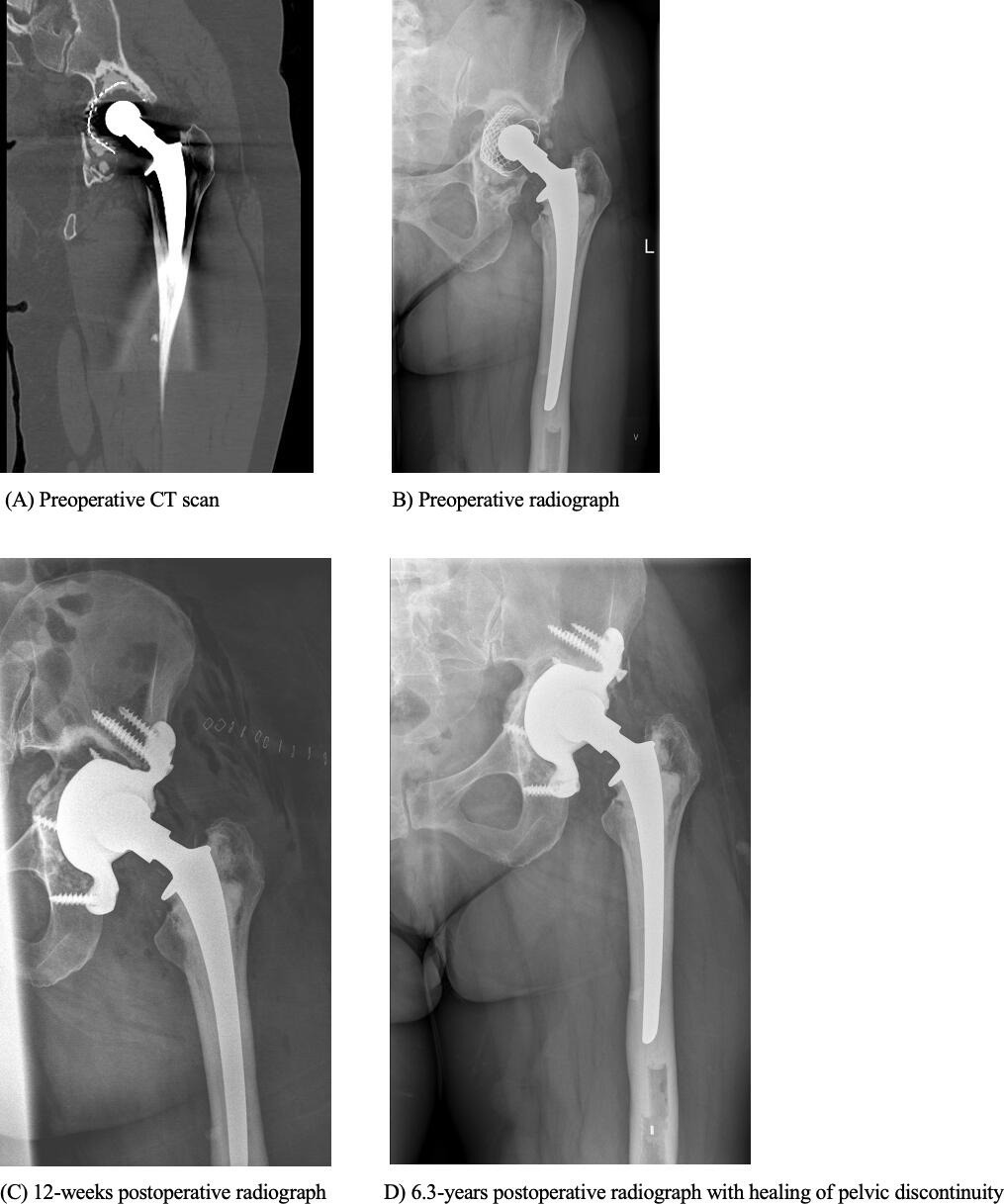 Fig. 4 
          a) Preoperative CT scan, coronal view of a 64-year-old female. b) Preoperative radiograph, anteroposterior (AP) view. c) Postoperative radiograph at 12 weeks, AP view. d) Postoperative radiograph at 6.3 years with healing of pelvic discontinuity, AP view.
        