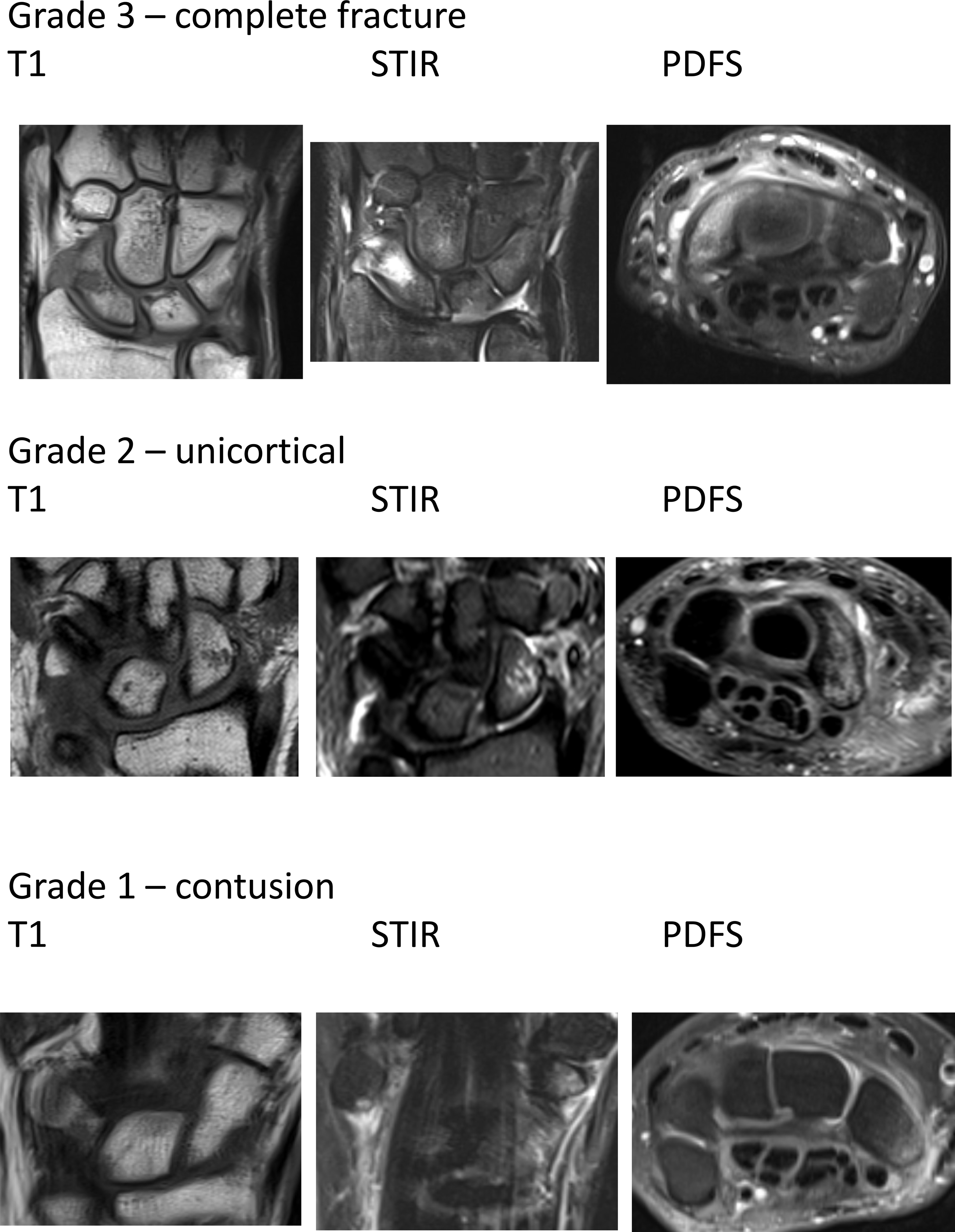 Fig. 1 
            Examples of MRI grading system. PDFS, Proton density Fat Saturated; STIR, Short Tau Inversion Recovery.
          