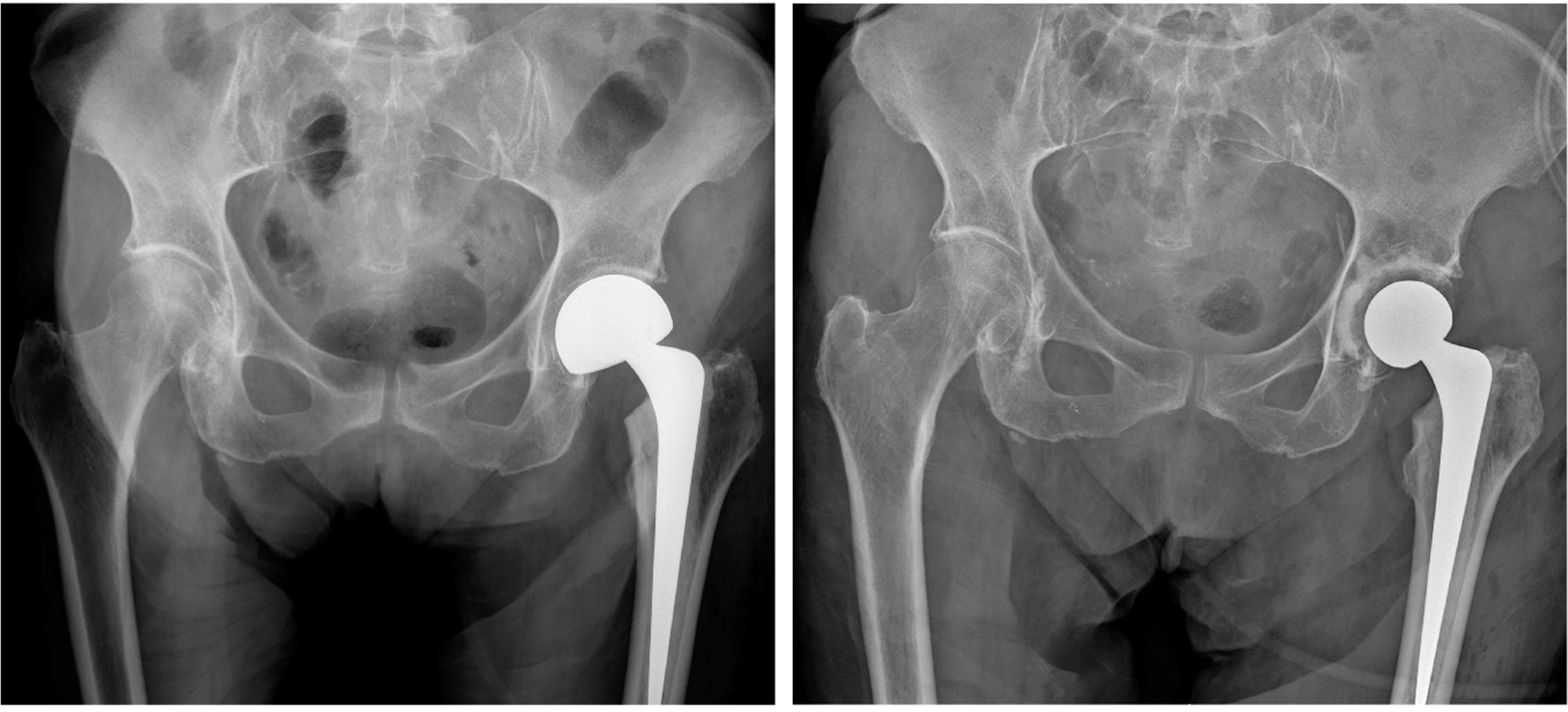Fig. 1 
            Preoperative (left) and postoperative (right) anteroposterior radiographs of a 76-year-old female patient who underwent a single-stage revision arthroplasty with conversion to total hip arthroplsaty for a left early-onset hemiarthroplasty periprosthetic joint infection. Postoperative radiograph demonstrates a cemented acetabular polyethylene liner and revised cement femoral implant.
          
