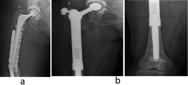 Fig. 2 
          a) Preoperative radiograph of a failed periprosthetic fracture fixation with profound bone loss. b) Postoperative radiograph at nine years follow-up.
        