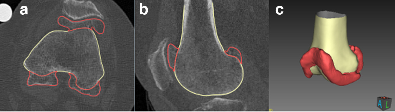 Fig. 1 
            Imorphics’ osteophyte detection algorithm identifies the osteophyte volumes in a CT image. Yellow is osteophyte-free surface, red osteophyte volume surface. a) and b) CT slices; c) bone volume generated model.
          