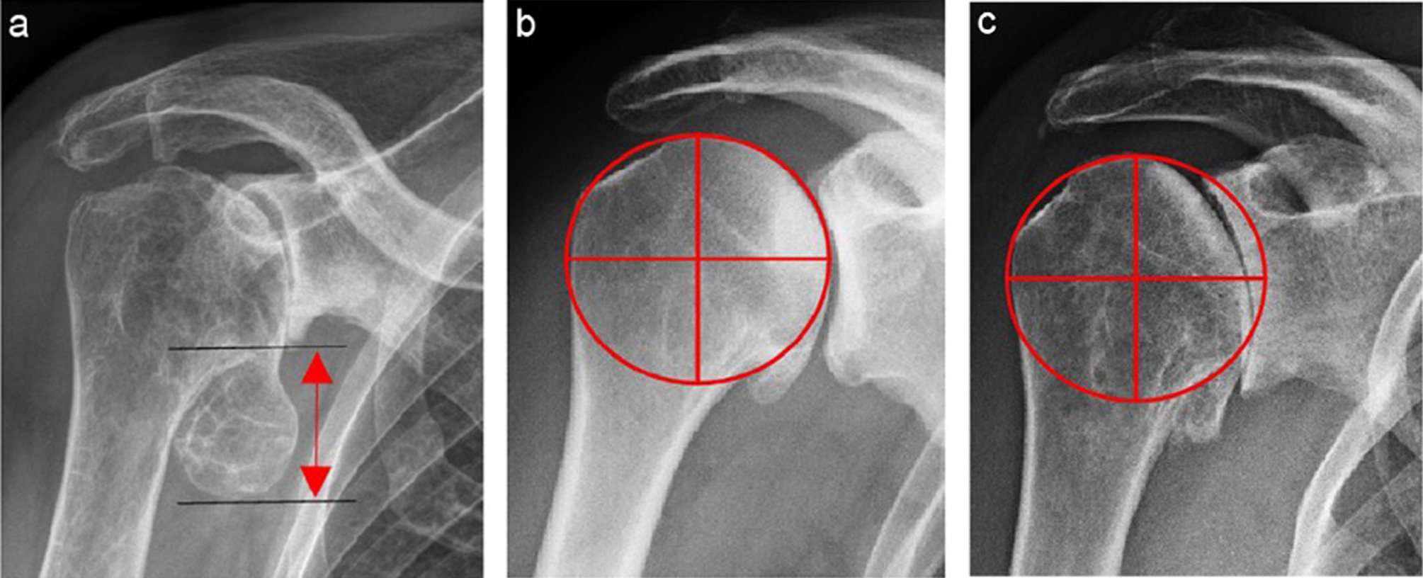 Fig. 1 
          Assessment of the humeral head in anteroposterior radiographs. a) Measuring the humeral osteophyte length in the supero-inferior direction. b) Spherical humeral head shape: A best-fitting circle is congruent with the cortical boundaries of the humeral head. c) Aspherical head shape: There is no congruency between the best-fitting circle and the humeral head cortex.14
        