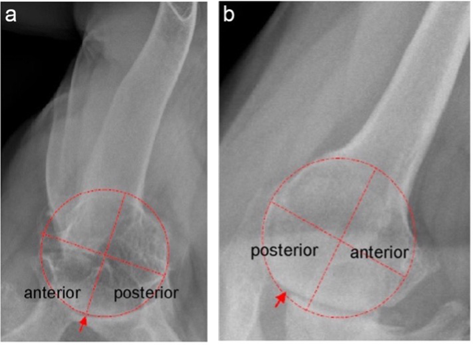 Fig. 2 
          Assessment of the humeral head in axillary radiographs. a) Centred apex (arrow), in line with the centre of rotation of a best-fitting circle at the humeral head cortex. b) Decentered humeral head apex (arrow). The centre of rotation is not in line with the apex.14
        