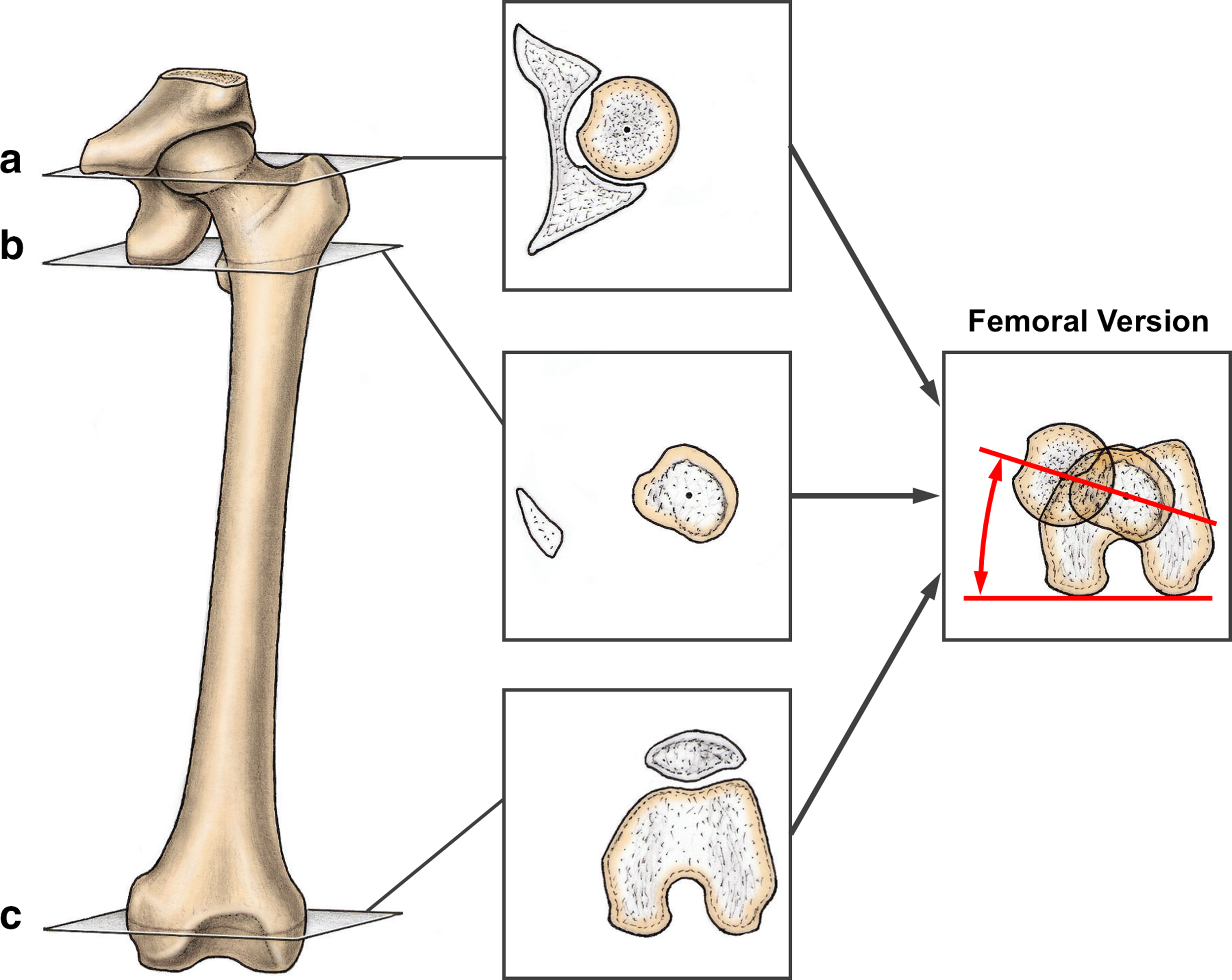 Fig. 2 
          Measurement of femoral version using the method described by Murphy et al20 is shown using three axial (transverse) CT or MR images. Femoral version is calculated using a line connecting a) the femoral head centre, b) the base of the femoral neck, and c) the posterior condylar axis of the distal femur. Figure reprinted with permission from Lerch et al.14
        