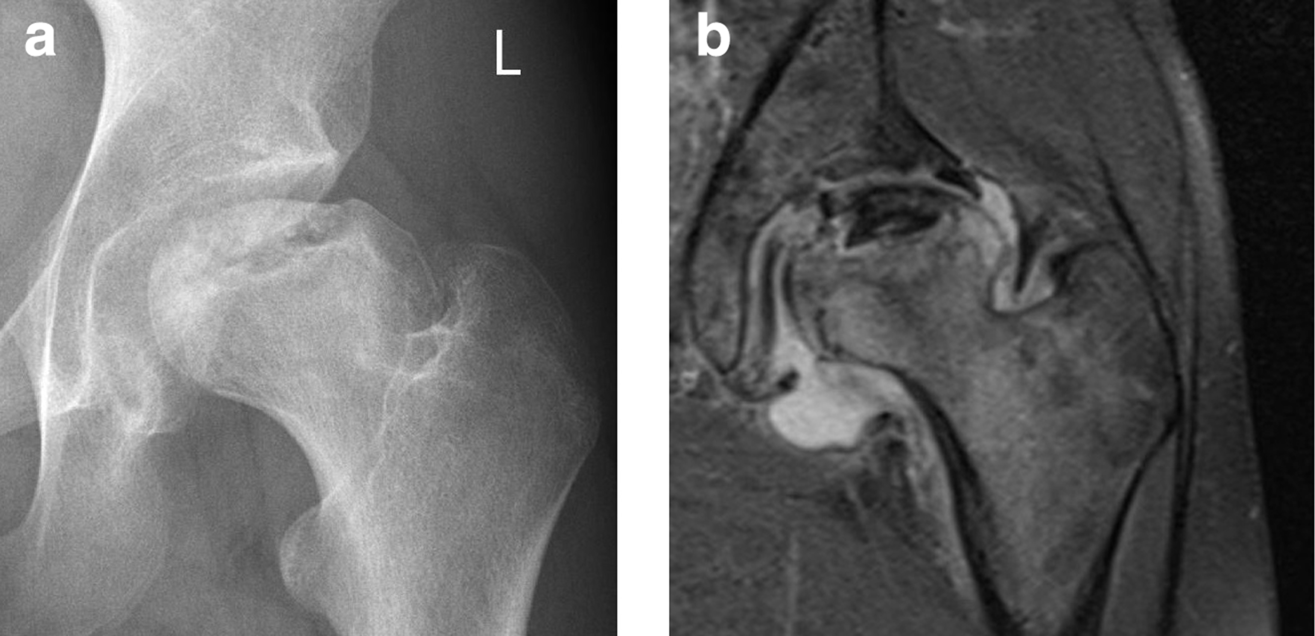 Fig. 1 
            Case one: a) Preoperative anteroposterior adiograph and coronal MRI of the left hip with femoral head subluxation; and b) flattening due to partial necrosis.
          