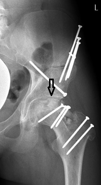 Fig. 2 
            Case one: Anteroposterior radiograph control of the left hip three months after periacetabular osteotomy and femoral head reduction osteotomy showing good joint congruency and containment but still visible osteotomies. Arrow points to the very small healthy part of the lateral pillar.
          