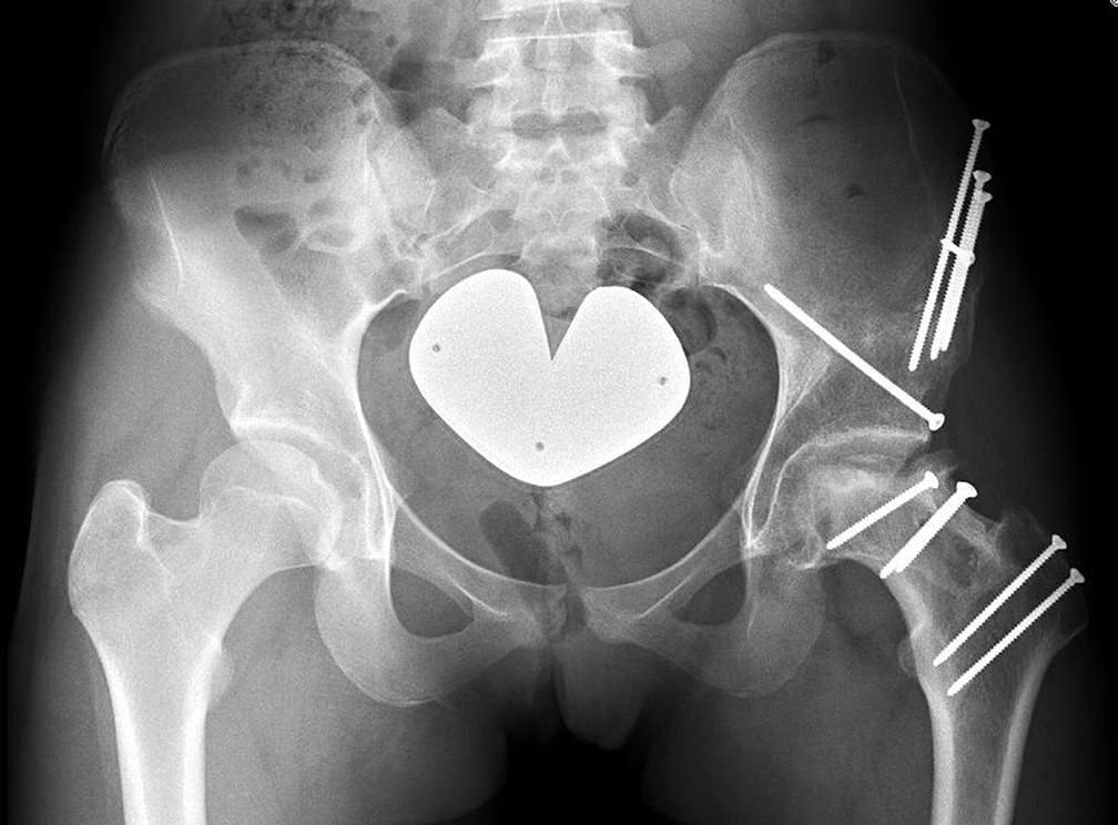 Fig. 3 
            Case one: Latest follow-up anteroposterior pelvic radiograph at three years after surgery showing a well centred femoral head with good coverage but partial resorption of the necrotic part of the lateral pillar and sclerotic changes of its metaphyseal part.
          