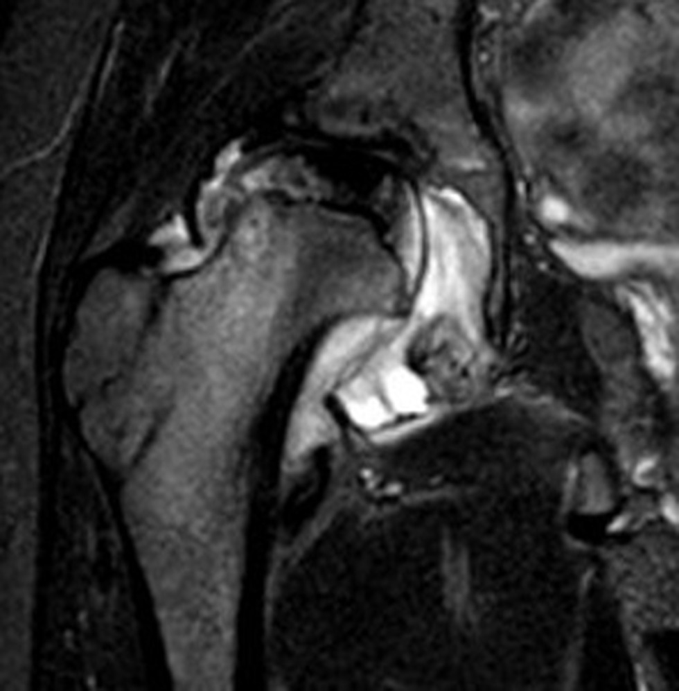 Fig. 4 
            Case two: Preoperative coronal pelvic MRI shows flattening of the right femoral head with central necrosis. The head is subluxed and the capsule is expanded due to joint effusion with a flattened acetabular roof.
          